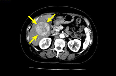 肝細胞がん症例CT画像（初発例）
